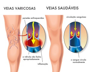 varizes e pernas cansadas